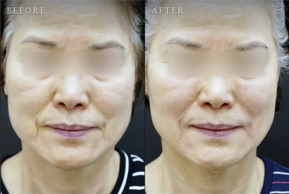 Ca trước–sau chính thức 24