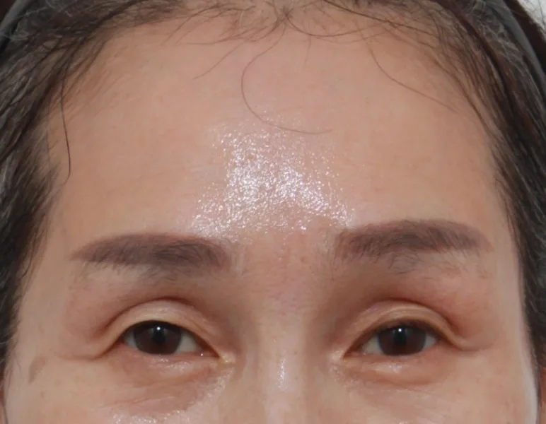 额部提升（50多岁）·正面·术后