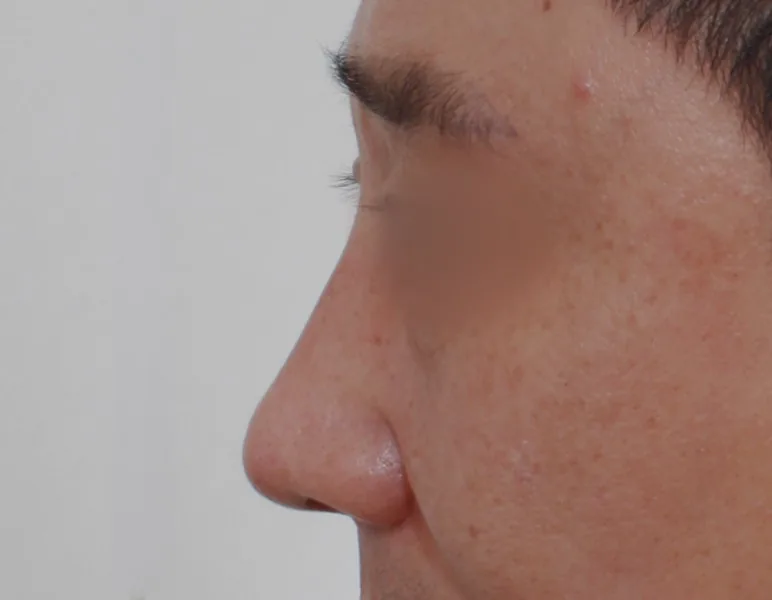 男性鼻整形：定制假体与鼻部延长·侧面·术后
