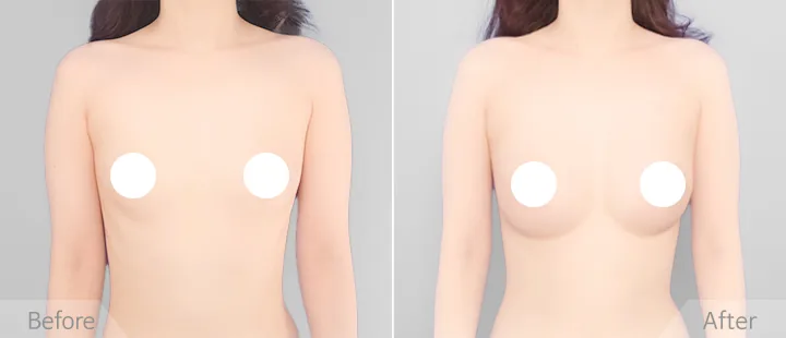 Breast augmentation