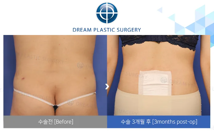Flank liposuction