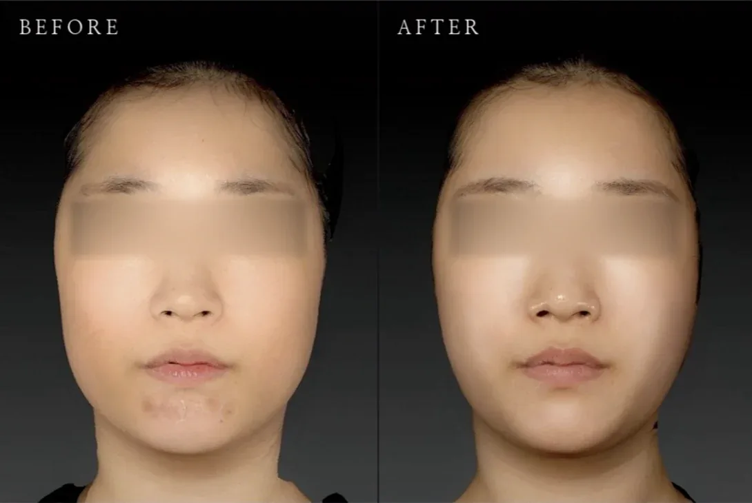 Ca trước–sau chính thức 15