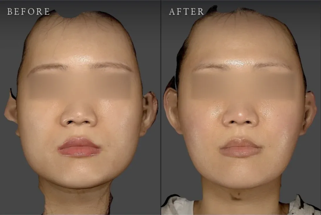 Ca trước–sau chính thức 17