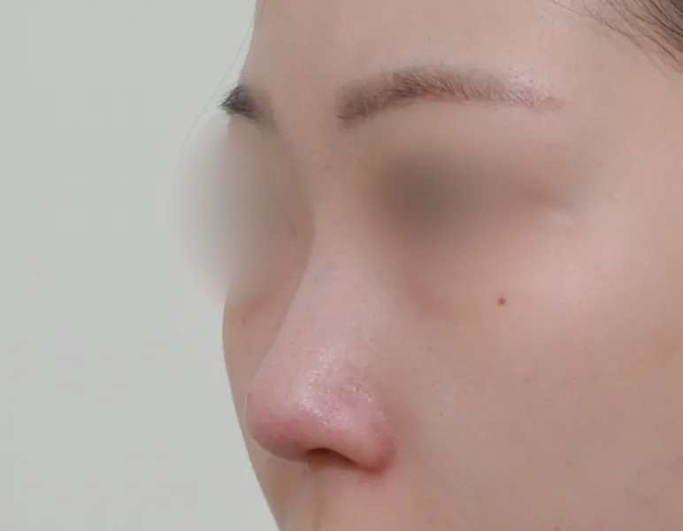 鼻整形：假体、自体肋软骨与鼻中隔软骨·45°侧面·术前