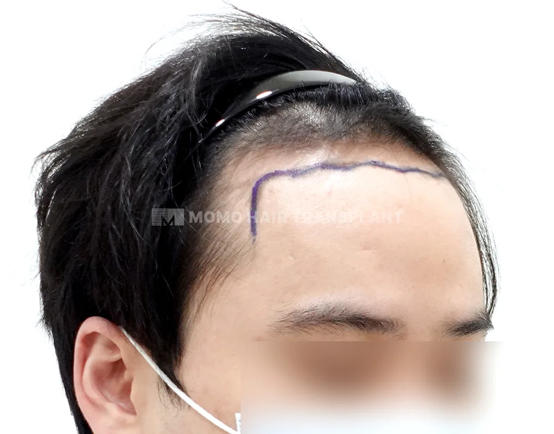 Ca trước–sau chính thức 1