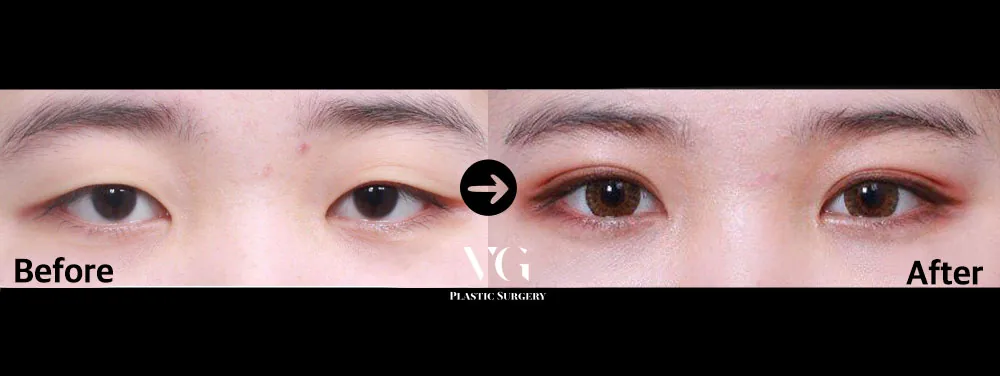 Very Good Plastic Surgery Before-and-after cases 3