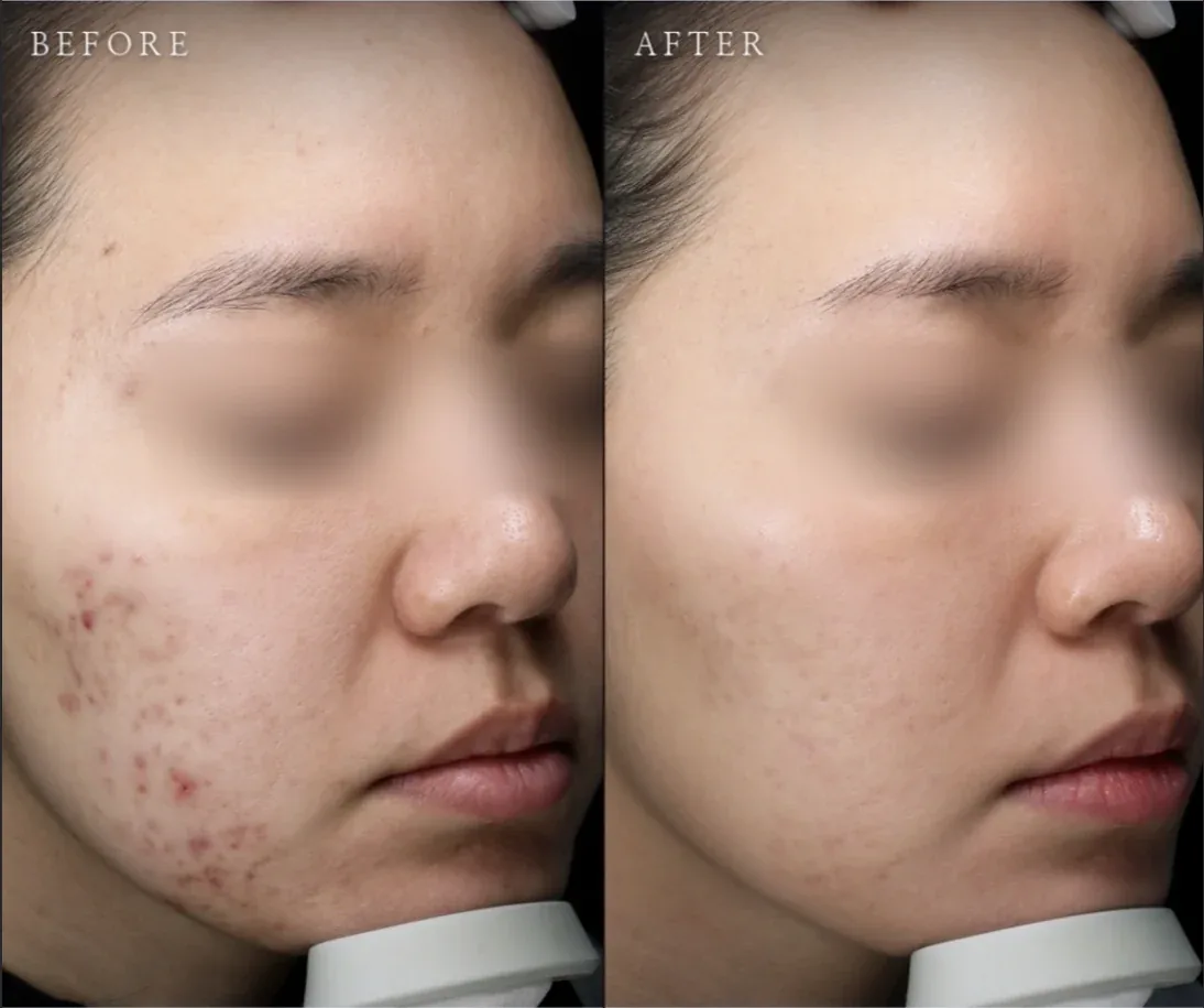 Ca trước–sau chính thức 11