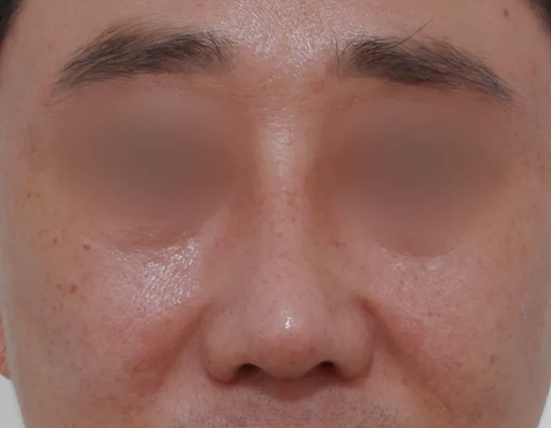 男性鼻整形：定制假体与鼻部延长·正面·术后
