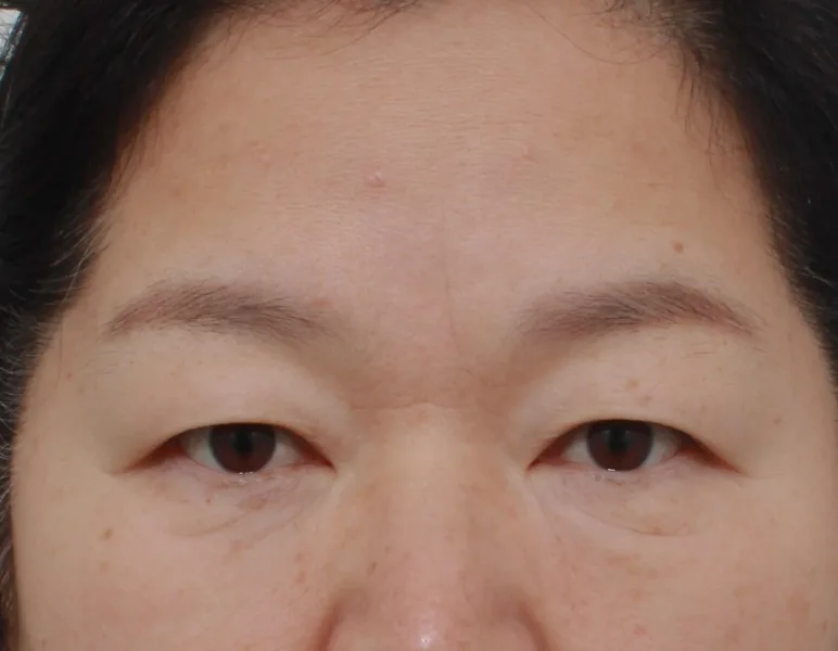 额部提升与下眼睑整形（50多岁）·正面·术前
