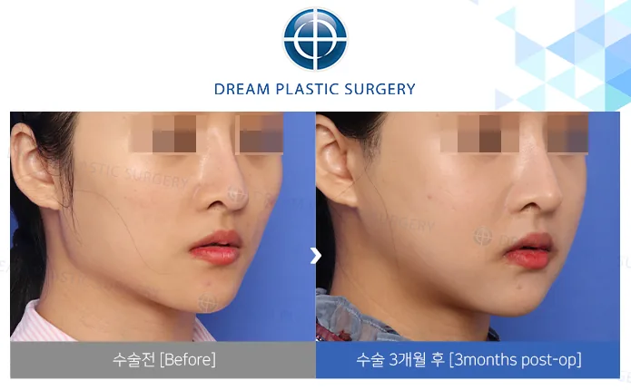 Mandibular-angle reduction + zygoma reduction