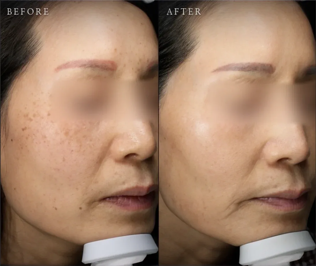 Ca trước–sau chính thức 10