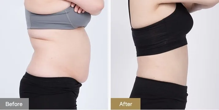 Cheongdam Youth Clinic official before-and-after case 1