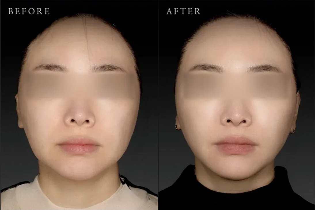 Ca trước–sau chính thức 16