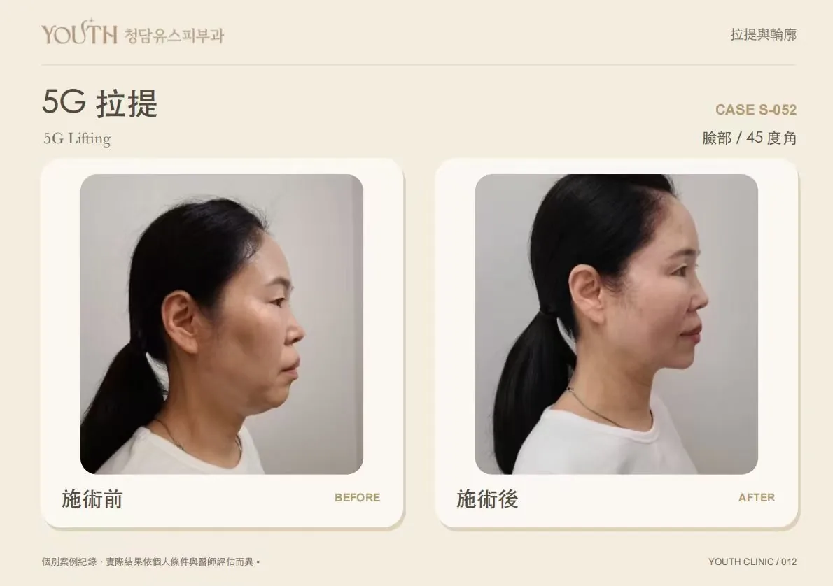 Cheongdam Youth Clinic official before-and-after case 10