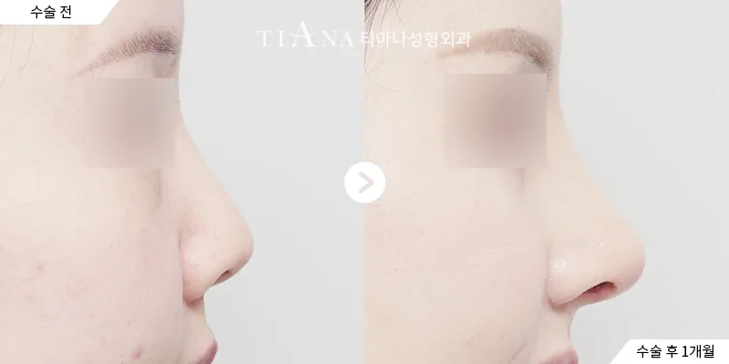 鼻整形与异物去除 · 侧面 · 左术前／右术后1个月