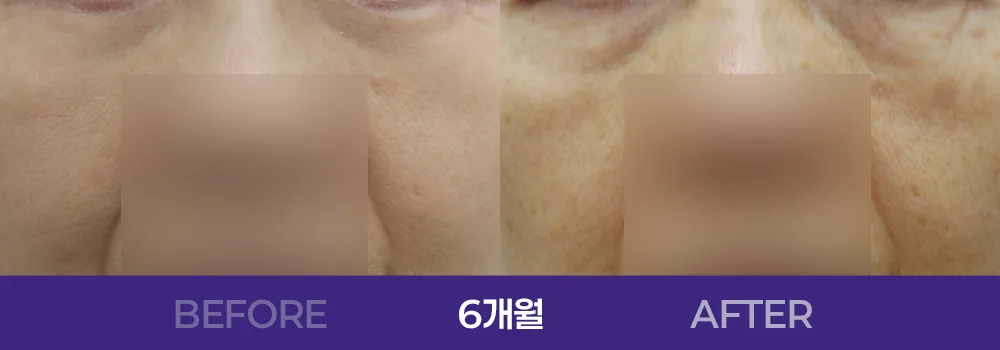 공식 전후 사례 3