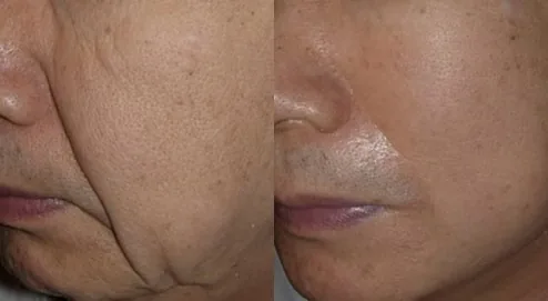 Cheongdam Youth Clinic official before-and-after case 9