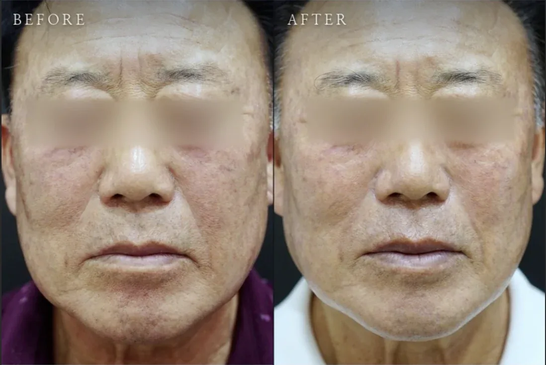 Ca trước–sau chính thức 25