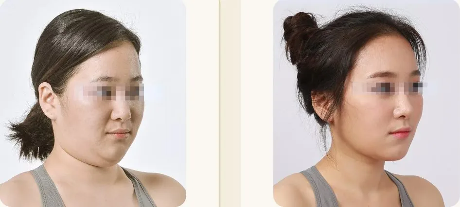 Cheongdam Youth Clinic official before-and-after case 12