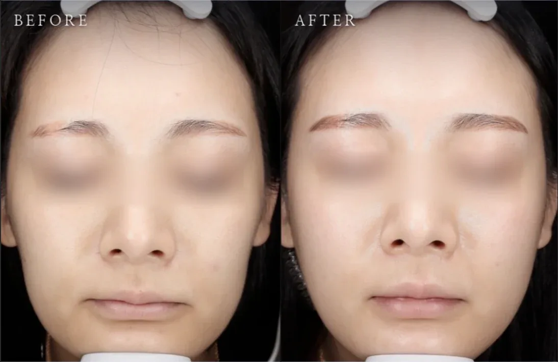 Ca trước–sau chính thức 4