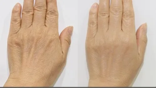 Cheongdam Youth Clinic official before-and-after case 7