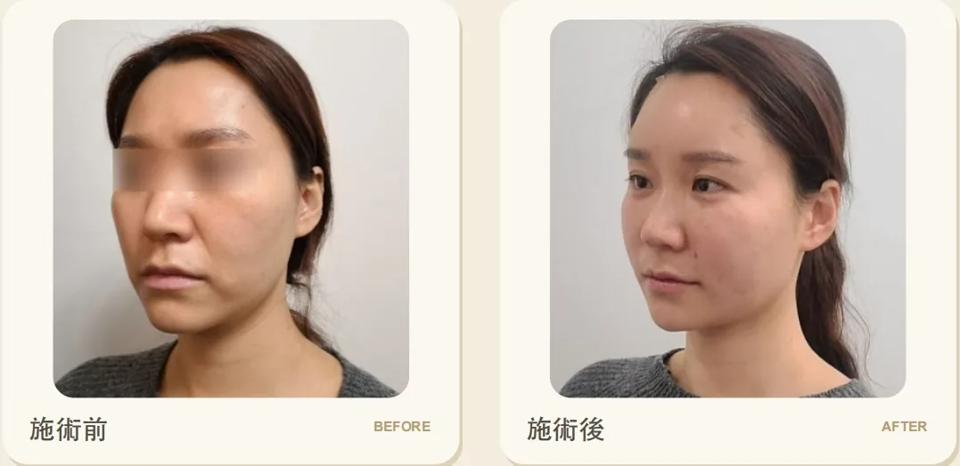 Cheongdam Youth Clinic official before-and-after case 11