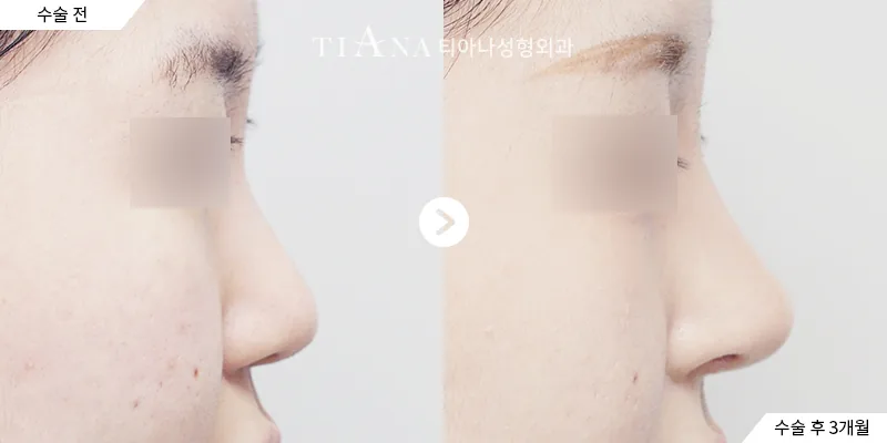 鼻修复与鼻形矫正 · 侧面 · 左术前／右术后3个月