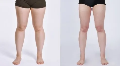 Cheongdam Youth Clinic official before-and-after case 3