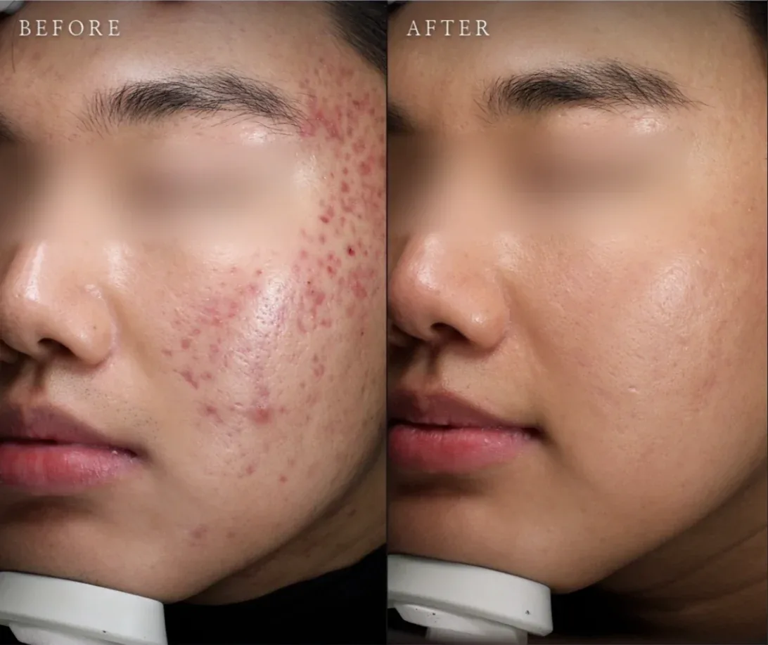 Ca trước–sau chính thức 5