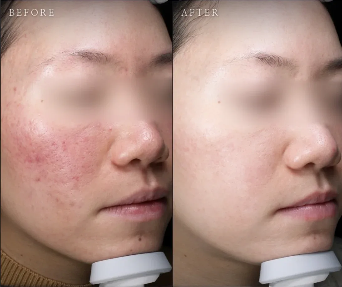 Ca trước–sau chính thức 12