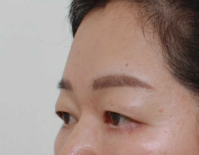 额部提升与下眼睑整形（50多岁）·45°侧面·术后