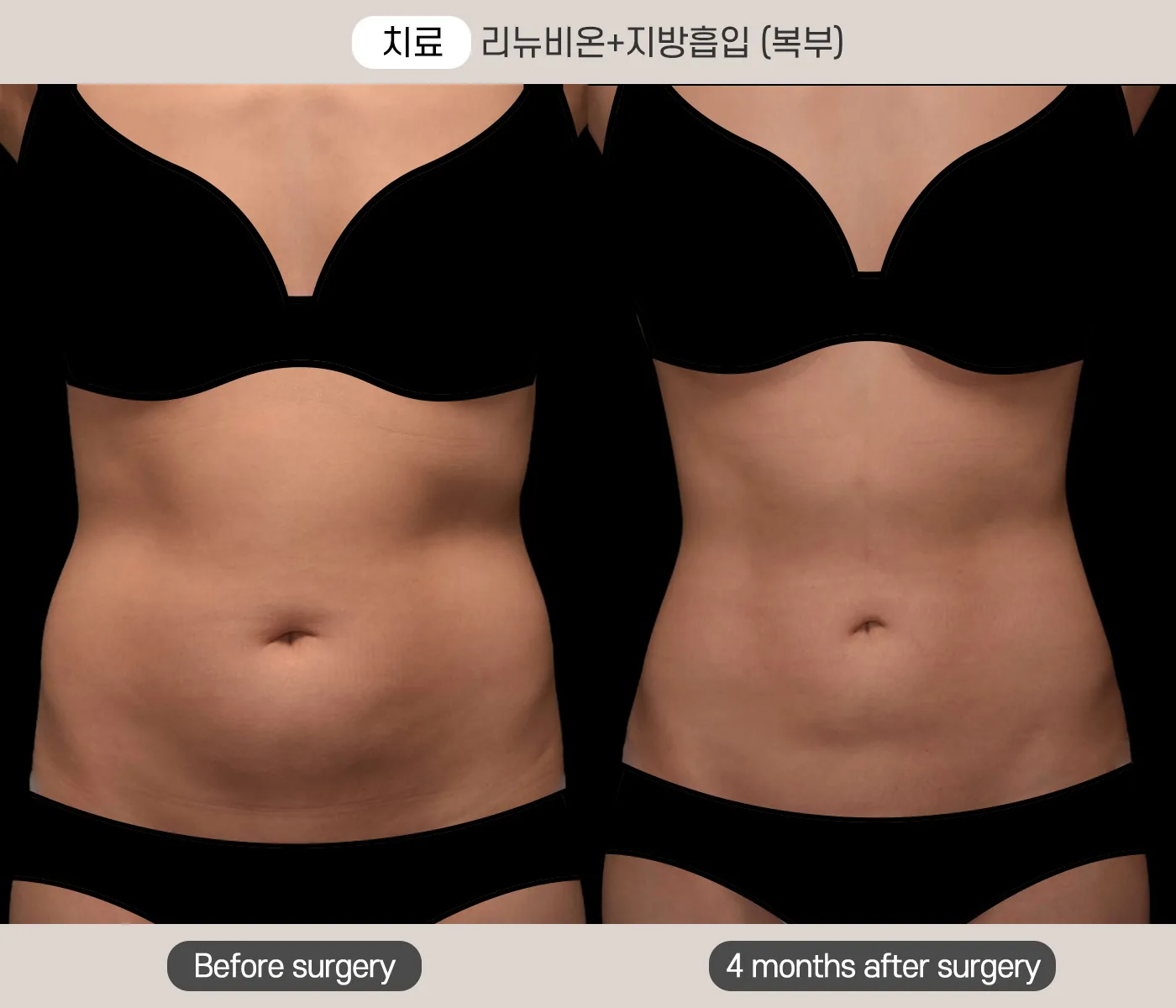 韩国丽迪安医院女性腹部Renuvion紧肤联合吸脂术前术后4个月案例