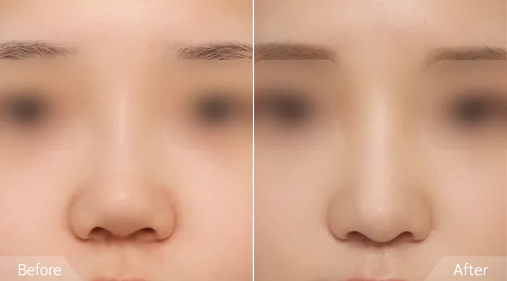 Rhinoplasty (short-nose correction)