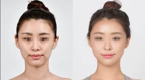 Cheongdam Youth Clinic official before-and-after case 8