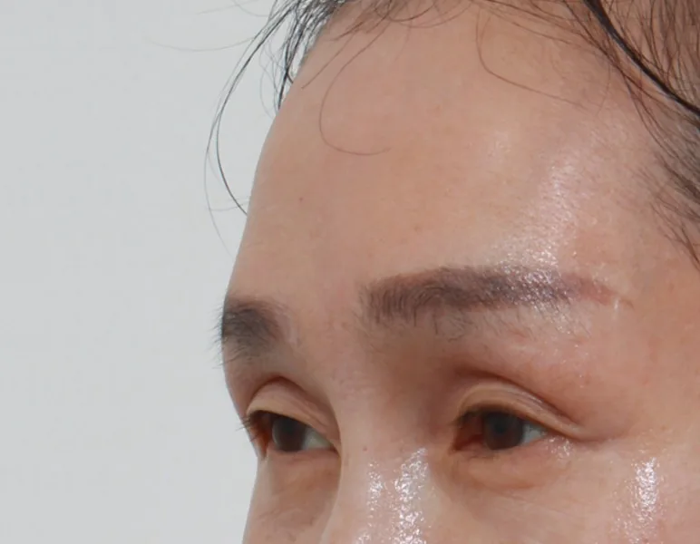 额部提升（50多岁）·45°侧面·术后