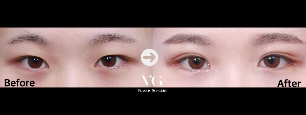 Very Good Plastic Surgery Before-and-after cases 2