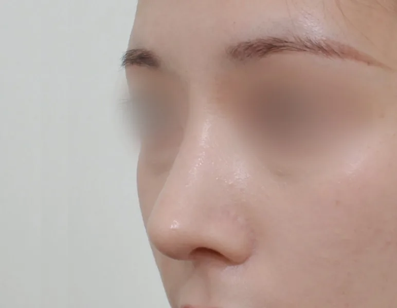 无假体鼻整形：驼峰调整与鼻部延长·45°侧面·术后