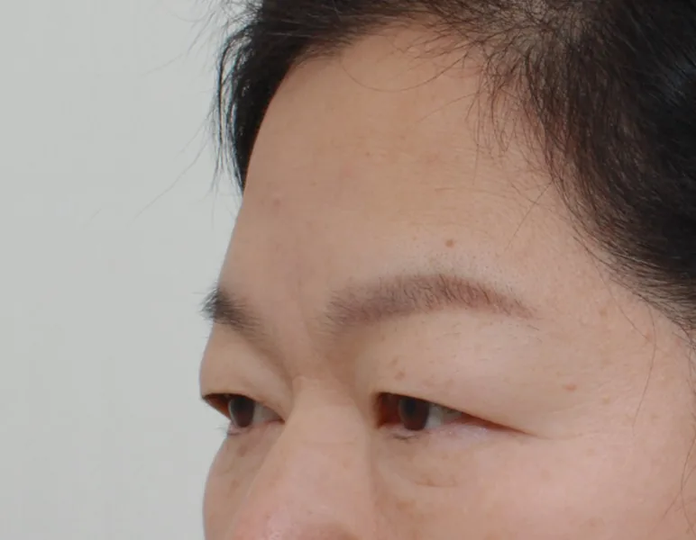 额部提升与下眼睑整形（50多岁）·45°侧面·术前