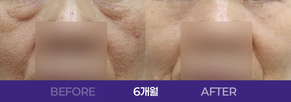 공식 전후 사례 2