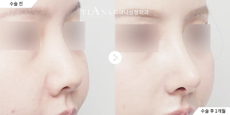 鼻整形与异物去除 · 斜侧面 · 左术前／右术后1个月