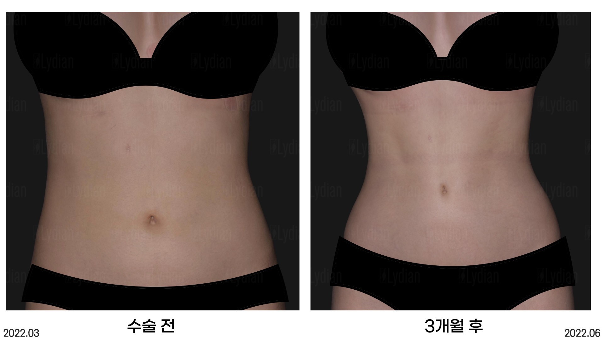 韩国丽迪安医院女性腰腹马甲线脂肪雕塑案例